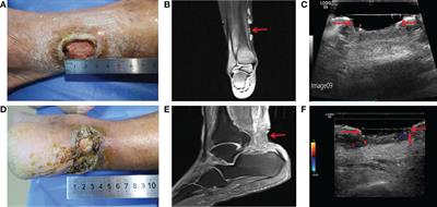 Case report: Successful treatment of human diabetic foot ulcer using low-intensity diagnostic ultrasound combined with microbubbles: Two cases